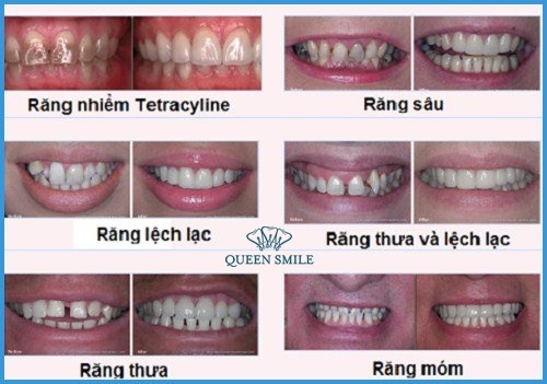 bọc răng sứ bao lâu và các trường hợp bọc răng sứ thẩm mỹ 