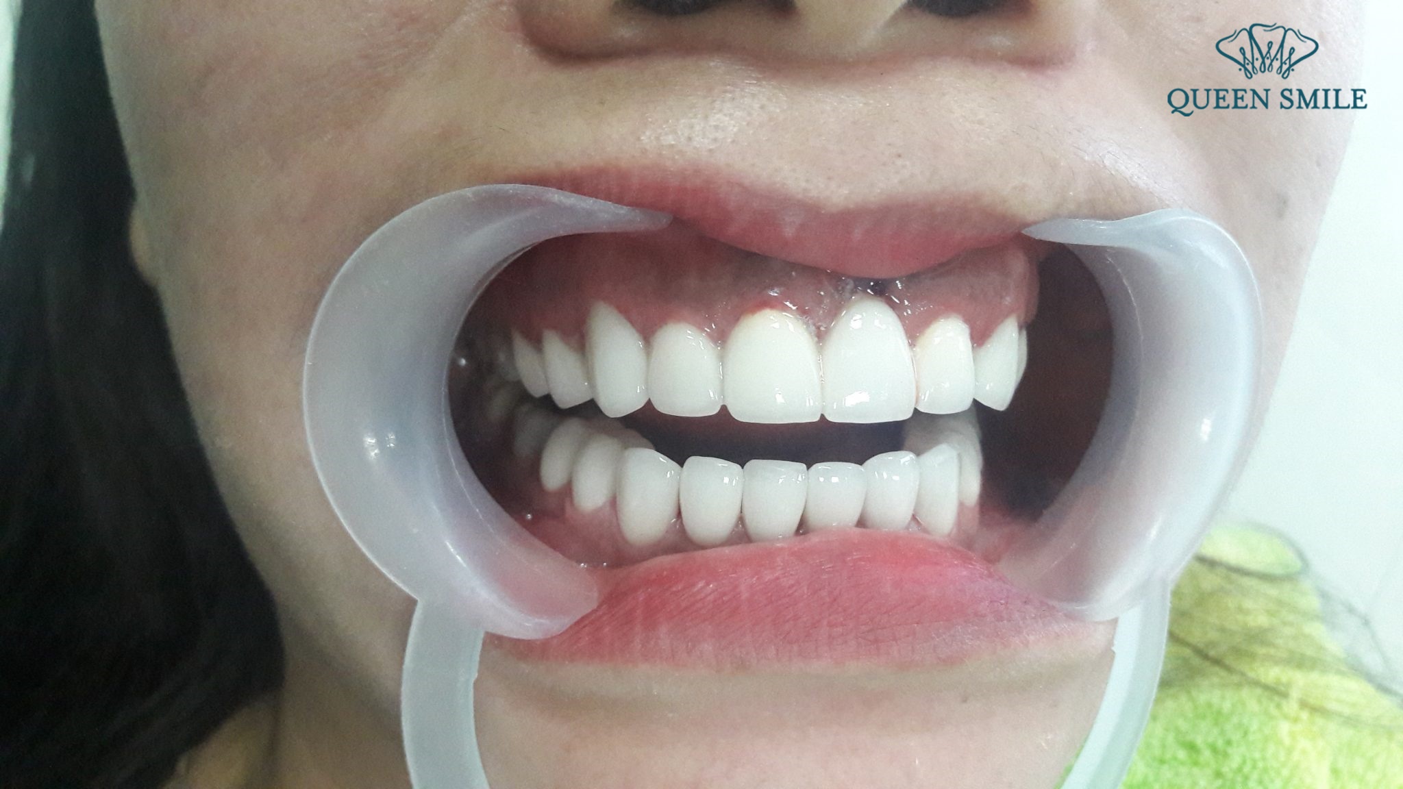 bọc răng sứ giá rẻ gây nên hậu quả nghiêm trọng 
