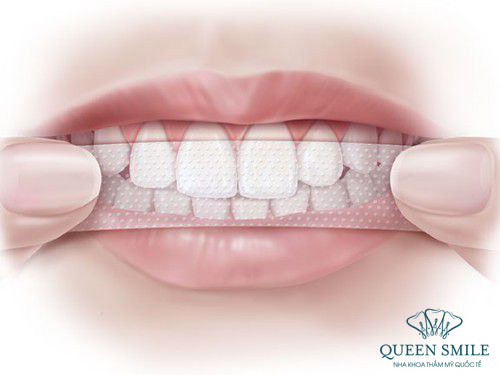 miếng dán trắng răng được sử dụng rộng rãi 