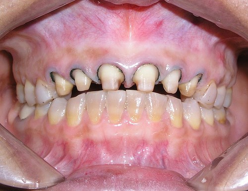 bọc răng sứ bị hỏng nặng sau 2 năm 