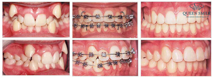 Trước và sau khi niềng răng mắc cài kim loại