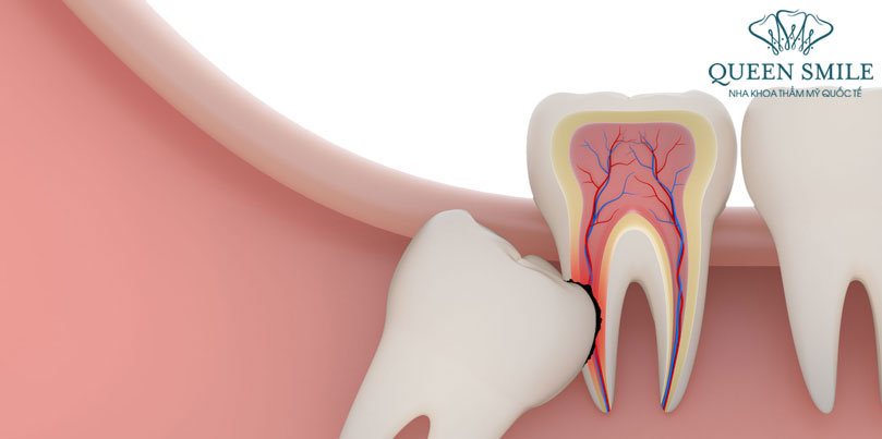 Răng khôn mọc ngầm gây khó khăn trong việc nhổ răng