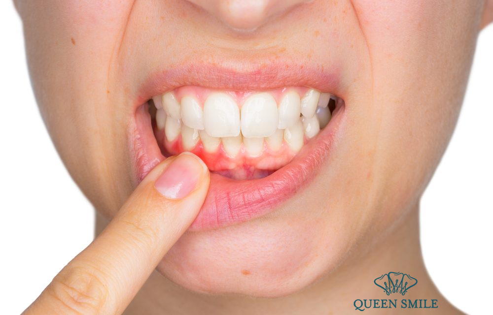 Bệnh viêm nướu khiến răng bạn dài ra và trông già hơn 