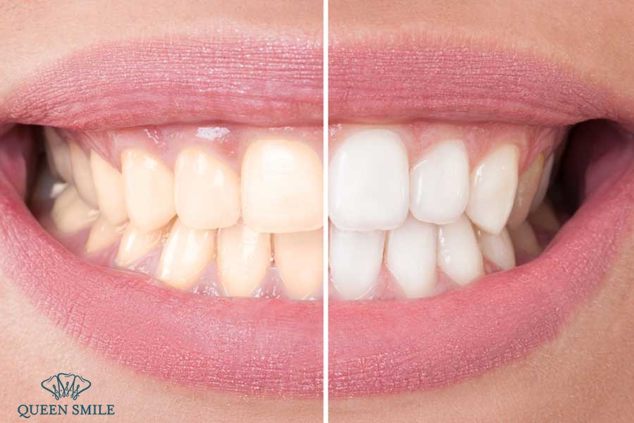 bột tảy trắng răng eucryl có thực sự tốt không