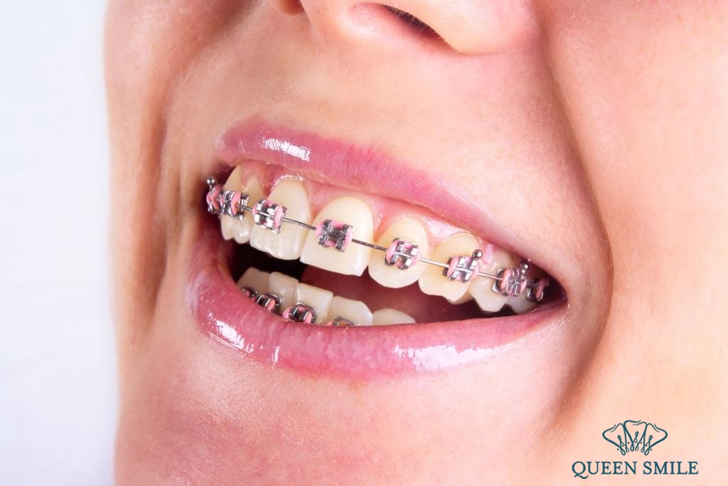 chữa cười hở lợi không phẫu thuật bằng niềng răng