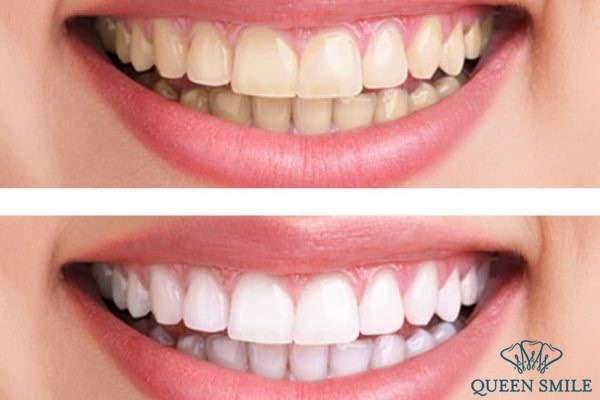 Có nhiều yếu tố ảnh hướng đến chi phí của công nghệ tẩy trắng răng như mức độ răng hư tổn, ố vàng và các máy móc,công nghệ được áp dụng chi-phi-tay-trang-rang-cong-nghe-moi-nhat