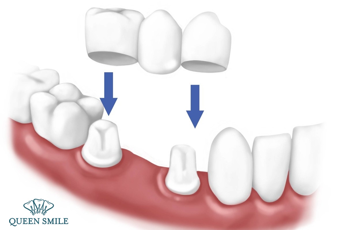 quy trình bọc răng sứ buổi gặp thứ 2