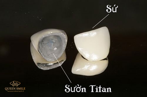 Răng sứ lõi Titan