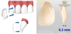 Mặt dán sứ Veneer