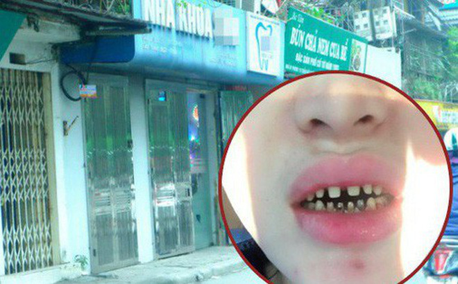 bọc răng sứ bị hỏng nặng sau 2 năm