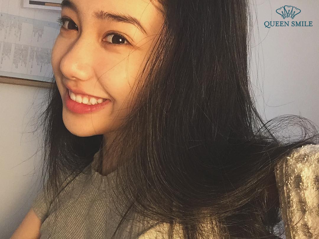 niềng răng hay bọc răng sứ
