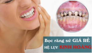 bọc răng sứ giá rẻ và hệ lụy