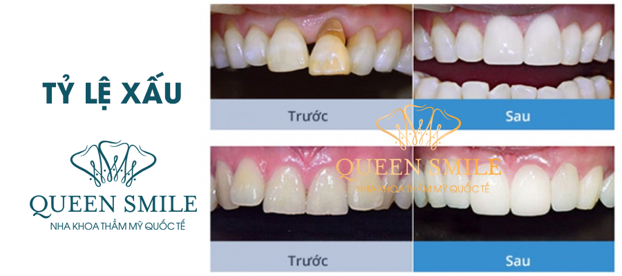 Bọc răng sứ khi tỷ lệ răng xấu