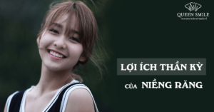 niềng răng có tác dụng gì