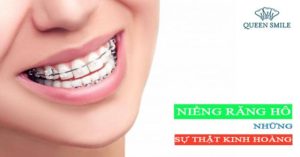 niềng răng hô