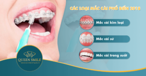 niềng răng giá bao nhiêu