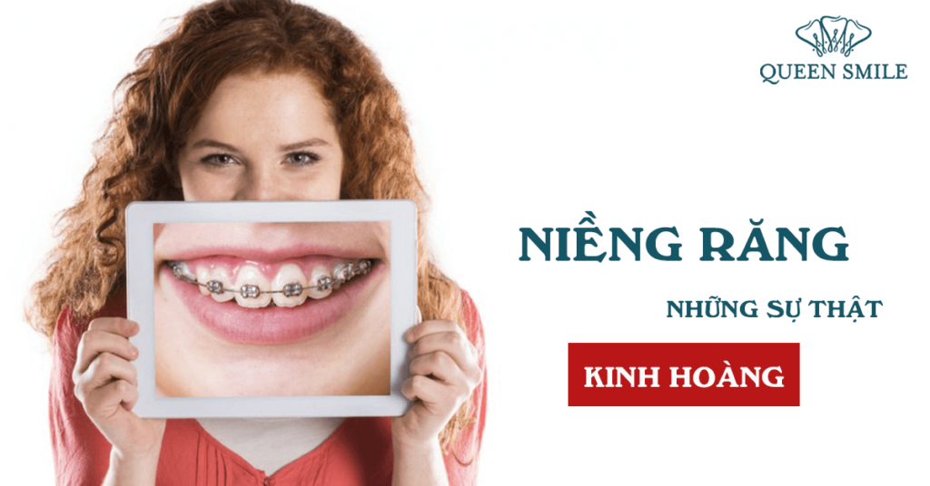 có nên niềng răng
