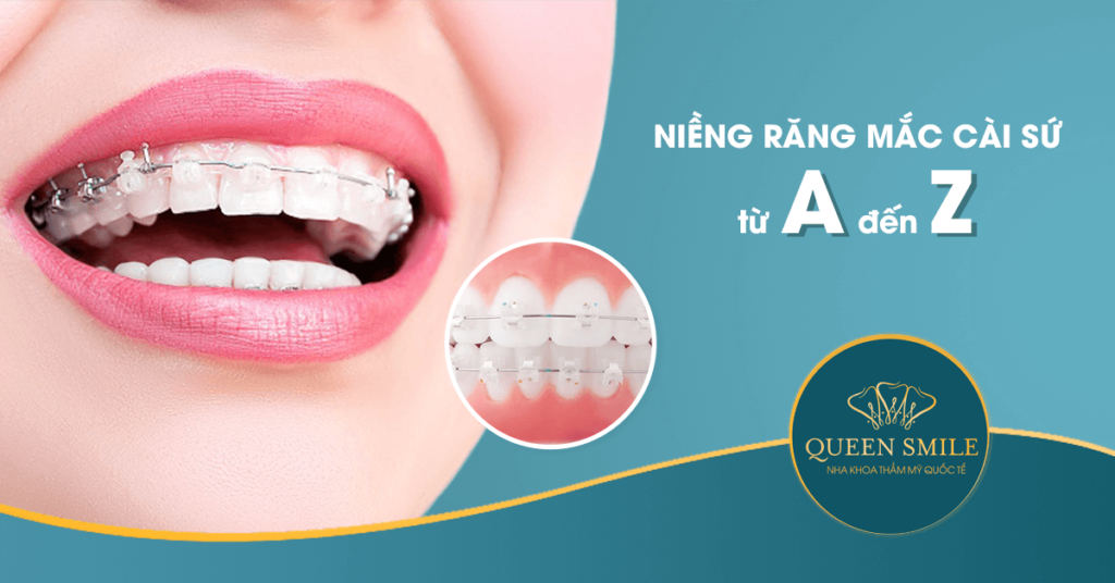 niềng răng mắc cài sứ