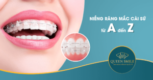 niềng răng mắc cài sứ