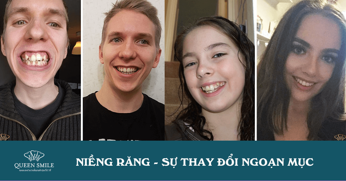 niềng răng là gì