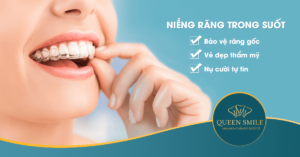 niềng răng trong suốt