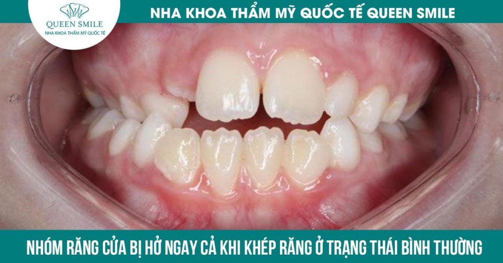 Khớp cắn hở là tình trạng nhóm răng cửa bị hở ngay cả khi khép răng ở trạng thái bình thường