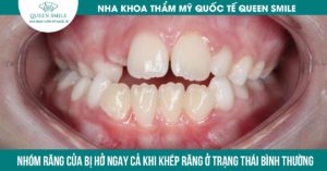 Khớp cắn hở là tình trạng nhóm răng cửa bị hở ngay cả khi khép răng ở trạng thái bình thường