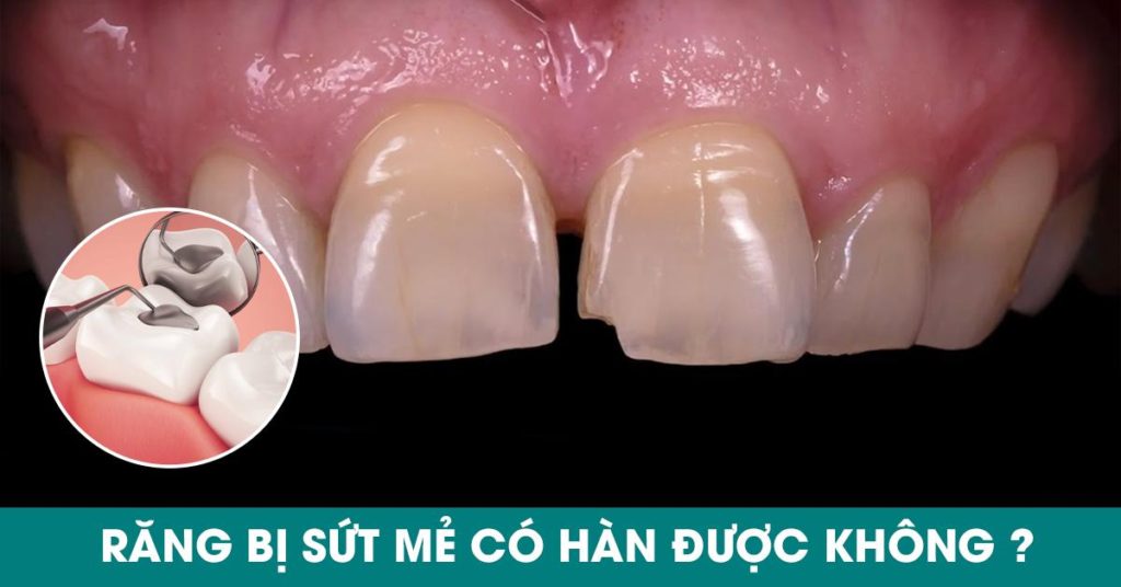 Răng sứt mẻ có hàn được không?