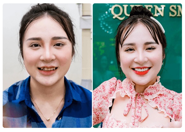 Sở hữu ngay nụ cười tỏa sáng khi bọc răng sứ tại Nha khoa thẩm mỹ Queen Smile nhé!