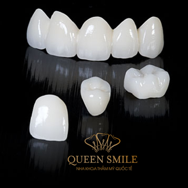 Răng toàn sứ Veneer Emax giống màu với răng thật, rất khó phân biệt đâu là phần bọc sứ