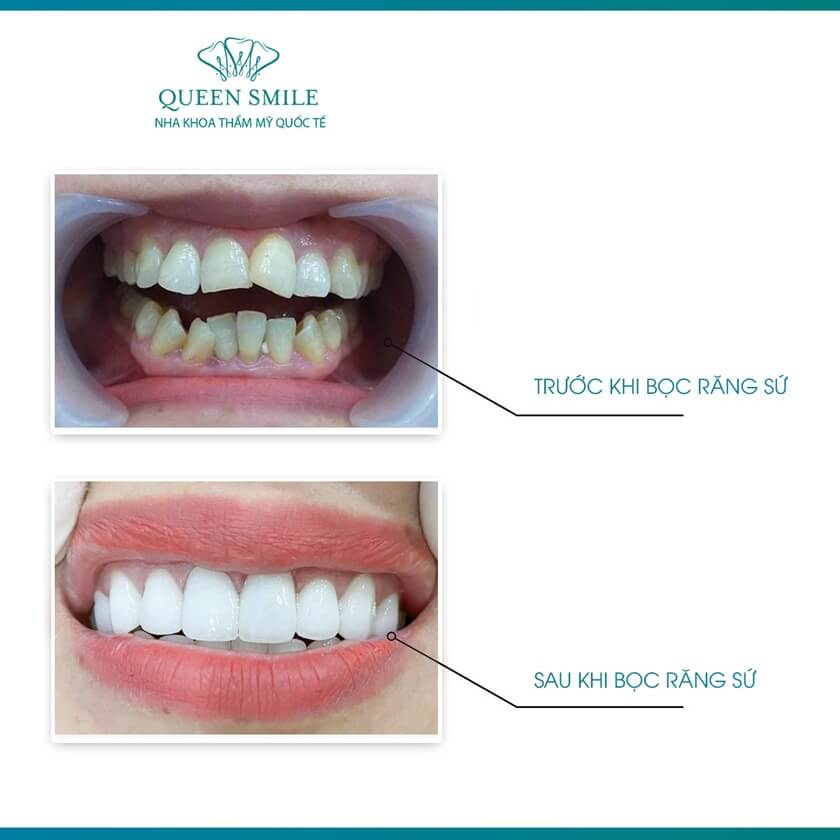 Bọc răng sứ là phương pháp thẩm mỹ nha khoa được nhiều kháchhàng lựa chọn