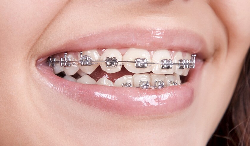Có nên bọc răng sứ và niềng răng?