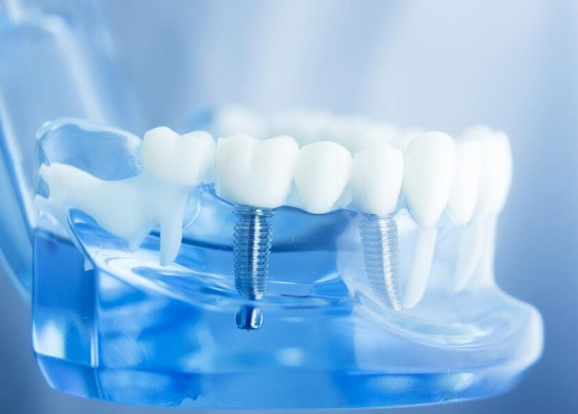 Quy trình cấy ghép Implant