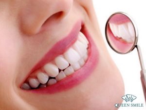 boc-rang-su-het-bao-nhieu