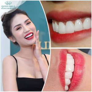 lam-rang-su-mat-bao-lau