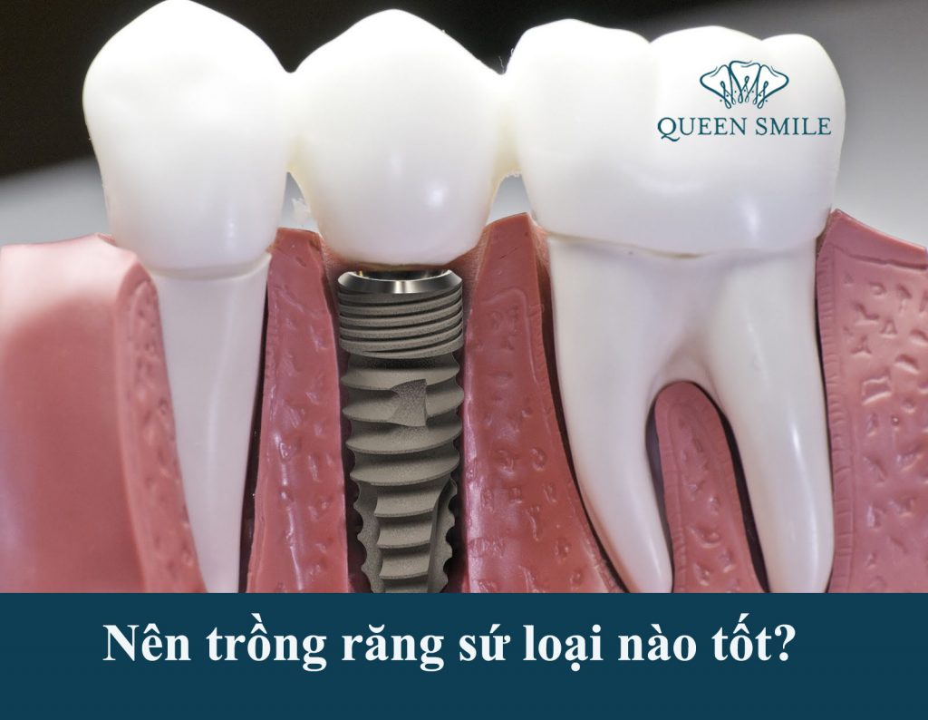 trong-rang-su-loai-nao-tot