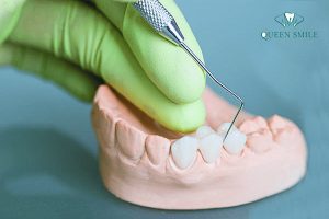 quy-trinh-boc-rang-su