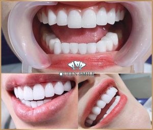 rang-su-bao-nhieu-tien