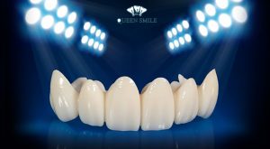 rang-su-cercon-la-gi