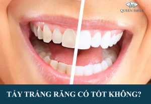 tay-trang-rang-co-tot-khong
