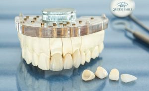 boc-rang-su-ceramill-co-tot-khong