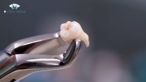 nho-rang-khon-co-nguy-hiem-khong