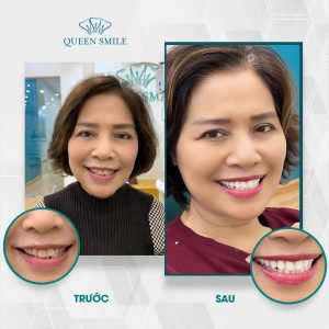 boc-rang-su-chinh-ho