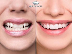 boc-rang-su-cho-rang-cua