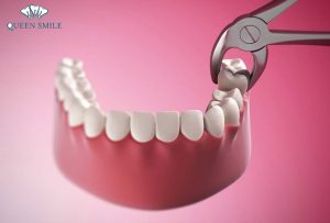 nho-rang-khon-ham-duoi-co-nguy-hiem-khong