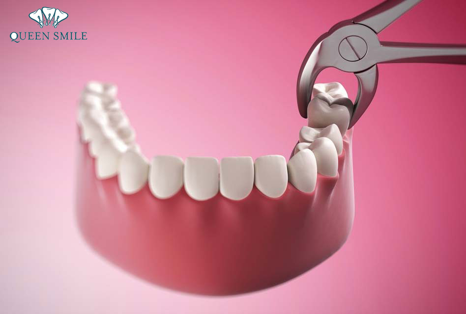 nho-rang-khon-ham-duoi-co-nguy-hiem-khong