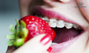 Một số loại thực phẩm/thức ăn những người mới niềng răng nên ăn - Các món ăn và thực phẩm được chế biến từ sữa như: bánh sữa, sữa chua, phô mai, sữa tươi, sữa chua uống,... - Các món ăn chế biến từ trứng như: trứng rán, trứng hấp, trứng sốt cà chua, trứng rang nhỏ,... - Trứng chứa nhiều vitamin D rất tốt cho sức khỏe răng miệng. Do đó bạn nên thêm trứng vào thực đơn sau khi niềng và siết răng nhé! - Với những bạn thích ăn bánh ngọt thì có thể lựa chọn các loại bánh mỳ cắt lát mềm, bánh bông lan, bánh ngọt xốp mềm không rắc hạt,... Những loại bánh này vừa ngon miệng và bổ dưỡng, vừa dễ nhai, dễ nhuốt. - Thức ăn được nấu nhừ, ninh chín, mềm như súp, cháo, bún, phở, mỳ trắng,... - Các loại thịt được chế biến nhỏ, nấu mềm như thịt lợn băm, thịt gà tách xương nấu mềm, hải sản hấp cắt nhỏ,... - Các loại rau củ luộc, hấp, được nấu mềm như cà rốt, của cải, rau cải,... Hoặc các món nghiền như khoai tây,... - Đậu phụ và các món ăn chế biến từ đậu phụ như đậu luộc, đậu sốt cà chua (không rán),... - Trái cây mềm như dâu tây, bơ, xoài,... - Sinh tố, nước ép trái cây, rau củ như nước ép cà rốt, táo, ổi, dưa hấu, cần tây, cam,...  - Các thực phẩm xốp, mềm như: Ngũ cốc, các loại mì, cơm nấu chín mềm,.. - Ngoài ra, bạn có thể dùng thêm các loại kem (ít lạnh vì lạnh quá sẽ khiến ê buốt răng), sữa, chocolate và các loại bánh như brownies, cookies mềm Ăn gì trong suốt quá trình niềng răng? Ngoài tuần đầu tiên sau khi mới niềng răng và 2-3 ngày sau siết răng nên ăn những thực phẩm mềm, dễ nhai thì bạn có thể ăn uống thoải mái trong quá trình niềng. Tuy nhiên, hoạt động ăn nhai trong thời gian đeo niềng cũng gặp khó khăn hơn so với bình thường. Do vậy, bạn cần phải cẩn trọng hơn trong việc ăn uống. Tốt nhất là nên có chế độ ăn uống tỉ mỉ, ưu tiên lựa chọn lựa những thực phẩm mềm và tốt cho răng miệng. Ngoài ra, trong thời gian đeo niềng bạn nên lưu ý một số điều sau khi ăn uống: - Hạn chế ăn đồ ăn quá cứng: Ăn quá nhiều đồ ăn cứng sẽ khiến răng và hàm phải vận động mạnh để nghiền nát thức ăn. Điều này không những khiến răng bị đau nhức mà còn có nguy cơ khiến cấu trúc hàm bị sai lệch. Nhiều trường hợp còn bị bung, hỏng mắc cài do ăn quá nhiều đồ cứng. - Nếu ăn thức ăn dai cứng, hãy cắt nhỏ chúng ra: Không nên dùng răng cắn, xé thức ăn dai, cứng trực tiếp vì sẽ khiến răng bị đau và bung mắc cài. Hãy cắt nhỏ thức ăn ra để việc nhai thức ăn được nhẹ nhàng và dễ dàng hơn. Đồng thời cũng bảo vệ sức khỏe cho răng niềng luôn được tốt. Nên kiêng ăn gì sau khi niềng răng? Để đảm bảo niềng răng đúng tiến độ, đạt kết quả như ý muốn và có hàm răng đều đẹp, khỏe mạnh sau niềng thì bạn cần chú ý một số việc sau: - Hạn chế ăn các loại bánh kẹo quá ngọt vì chúng chứa nhiều đường dễ khiến răng sâu nếu không vệ sinh sạch sẽ. Ngoài ra, nó còn có thể gây ra các bệnh lý răng miệng như viêm nướu, hôi miệng,... - Ăn ít đồ ăn cứng, dai vì nó sẽ khiến răng và hàm bị đau, ê, thậm chí là biến dạng cấu trúc hàm,... Từ đó làm ảnh hưởng đến quá trình và kết quả niềng răng. - Không nên ăn/nhai kẹo cao su vì nó dễ dính vào mắc cài, rất khó vệ sinh và làm sạch. - Hạn chế ăn và uống những thực phẩm sậm màu như soda, cà phê, trà,... vì chúng có thể khiến răng ố vàng. - Hạn chế uống bia, rượu, các đồ uống có chất kích thích vì chúng sẽ làm răng yếu và nhạy cảm hơn. - Tuyệt đối không hút thuốc lá bởi nó không chỉ là nguyên nhân dẫn đến hôi miệng mà còn làm răng ố vàng, xỉn màu. - Hạn chế ăn các loại thức ăn nhanh và đồ chiên rán vì chúng chứa nhiều tinh bột và dễ tạo thành mảng bám trên răng. Nếu không vệ sinh sạch sẽ dễ gây sâu răng. Hy vọng với những chia sẻ trên đây, bạn đã biết nên và không nên ăn gì sau khi niềng răng. Nếu có bất kỳ thắc mắc nào cần giải đáp, hãy liên hệ ngay với Queen Smile nhé! Chúc các bạn sớm tháo niềng và có hàm răng đều đẹp, khỏe mạnh như ý!