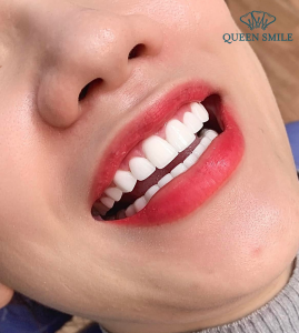 boc-rang-su-co-can-lay-tuy