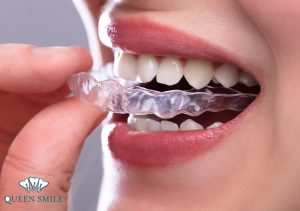 nieng-rang-invisalign-co-tot-khong