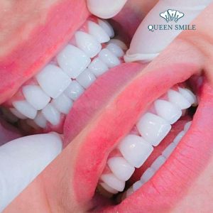 boc-rang-su-duy-tri-duoc-bao-lau